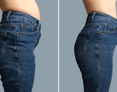 Før og efter billede - slankekur